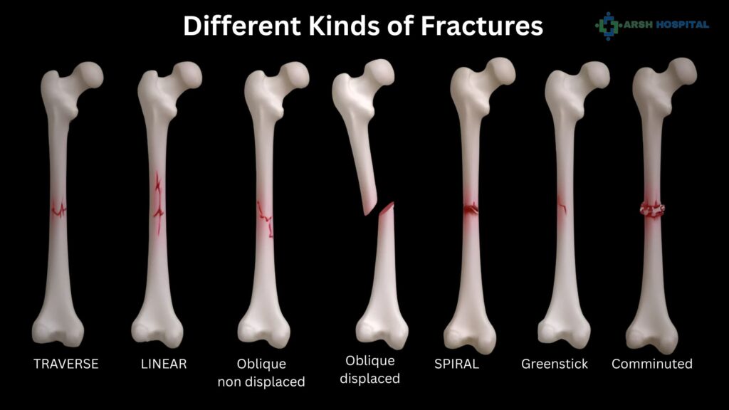 Different Kinds of Fractures and How to Treat and Fix Them.