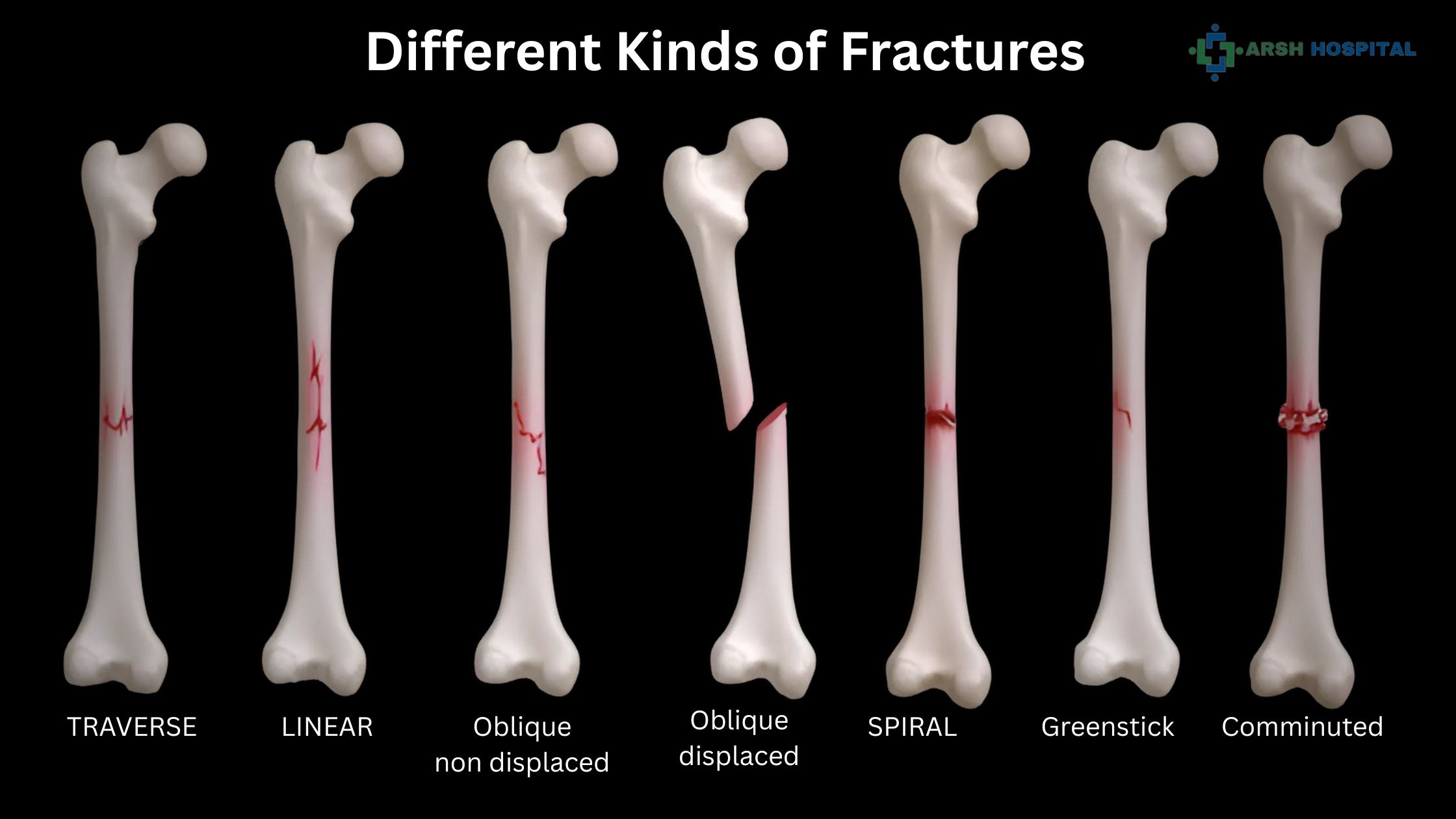 Different Kinds of Fractures and How to Treat and Fix Them.
